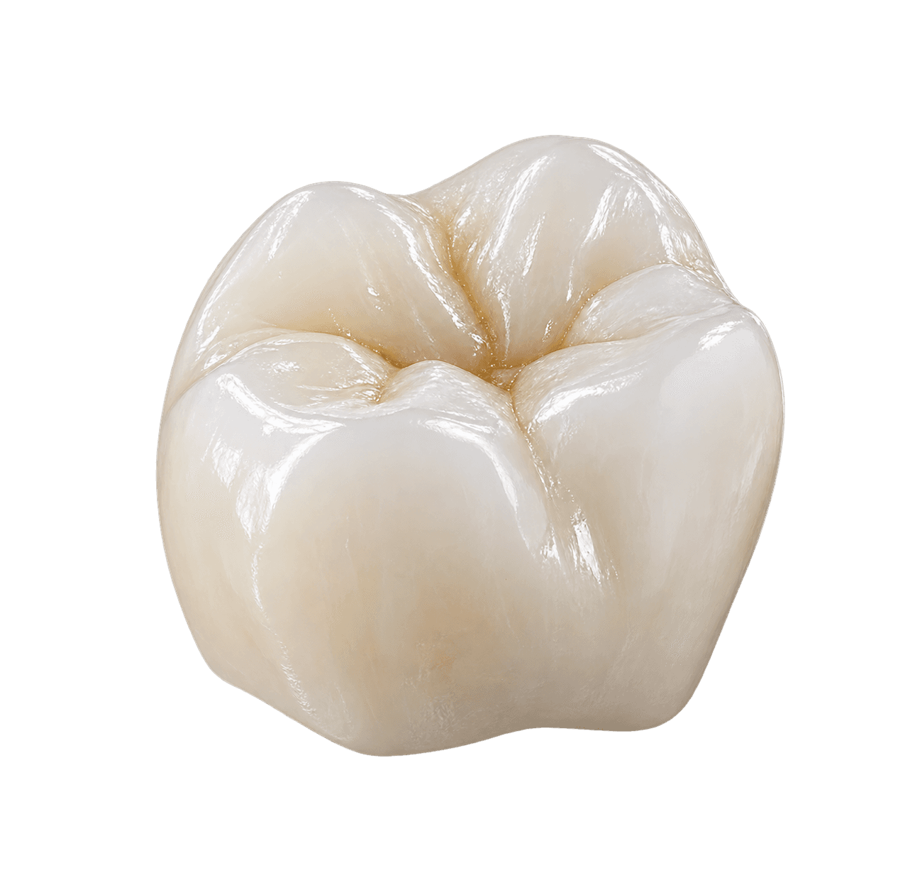 IPS e.max dental restoration