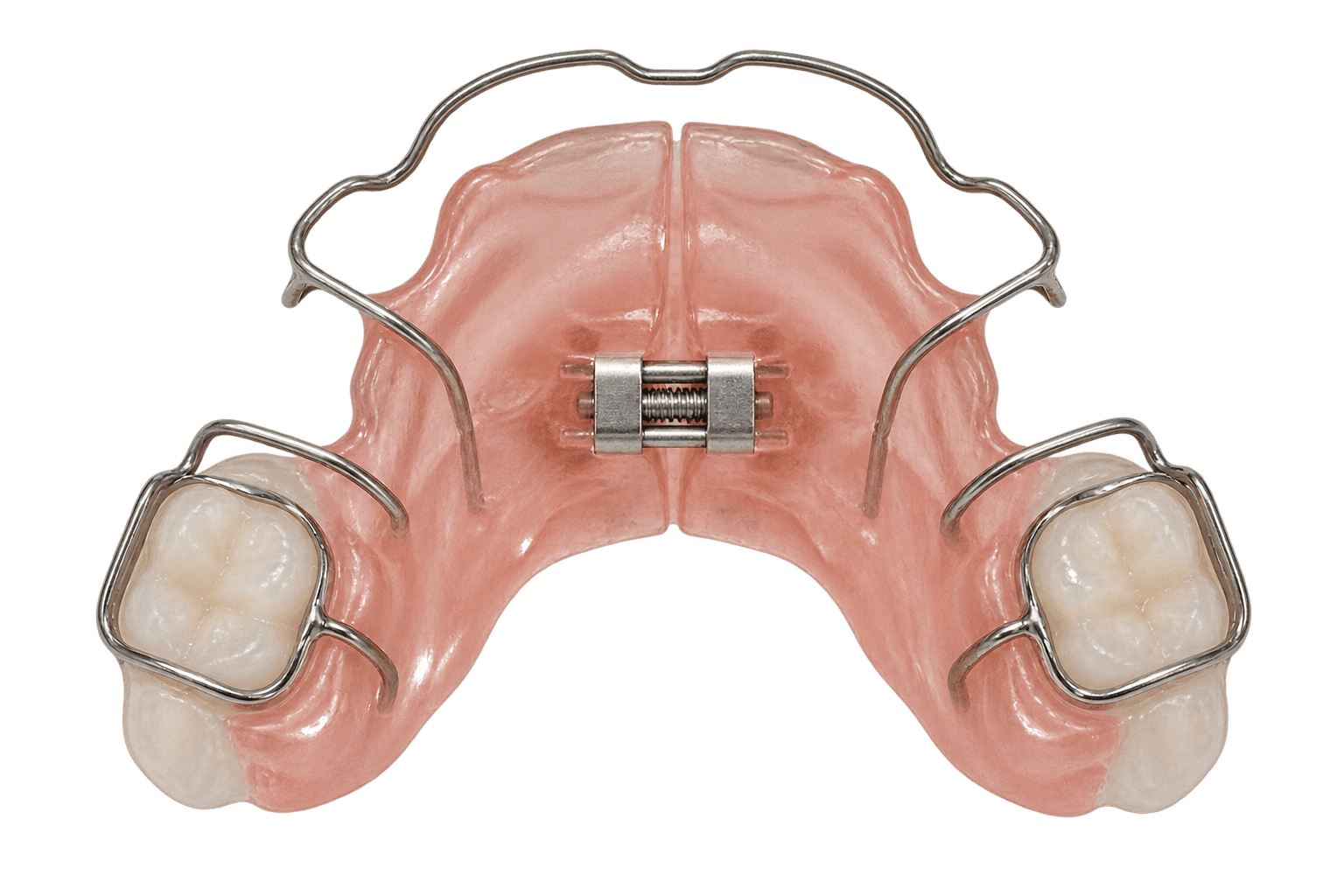 Orthodontic arch development appliance